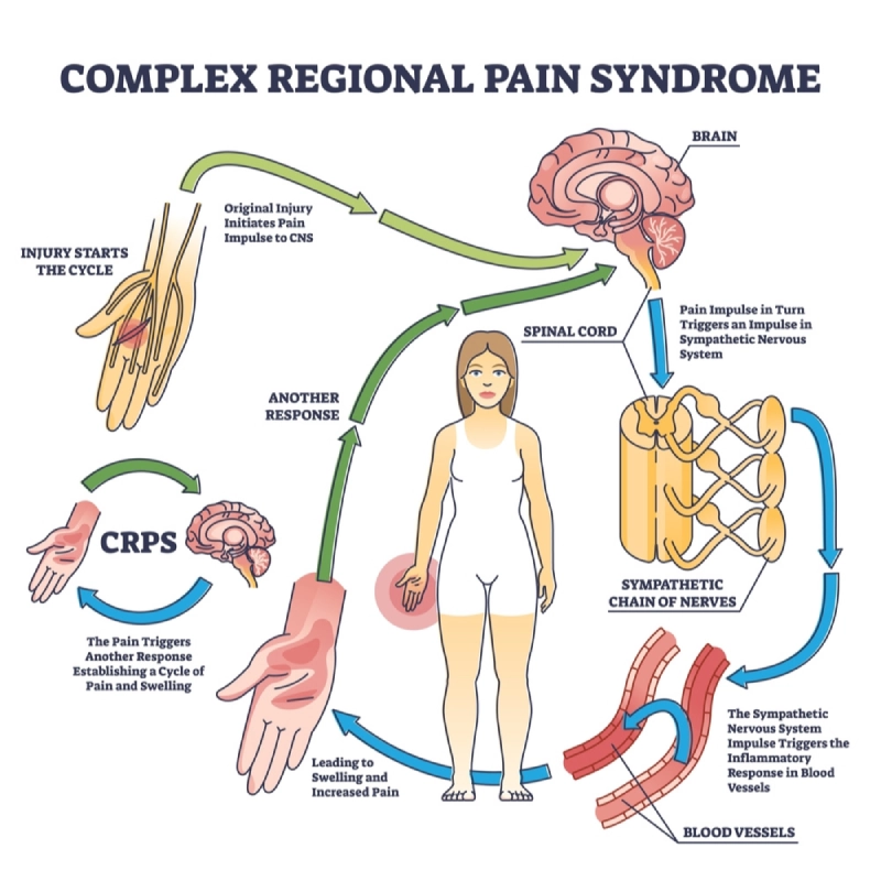 complex regional pain syndrome