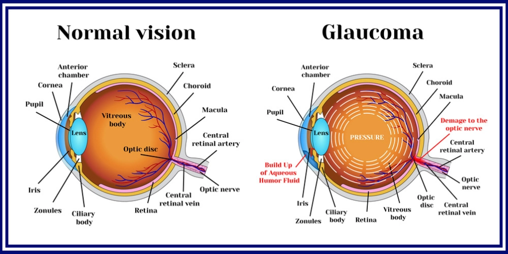 normal vision vs glaucoma