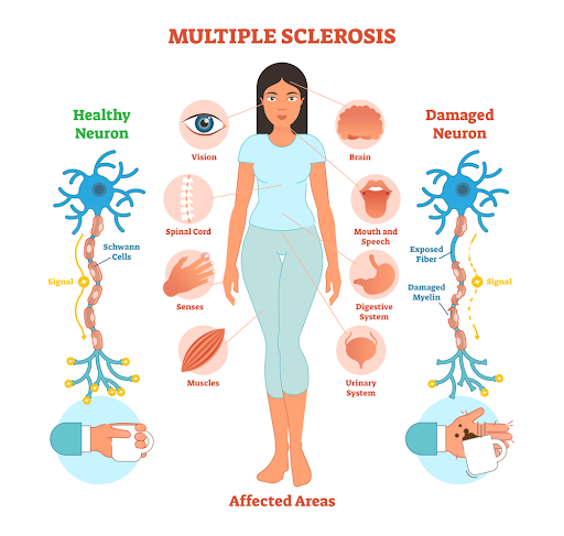 Marijuana and Multiple Sclerosis