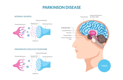 Marijuana and Parkinson’s Disease
