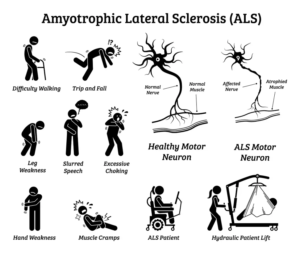 ALS disease signs