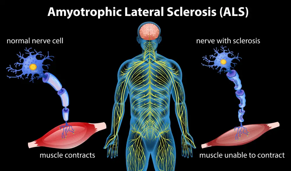 Anatomy of amyotrophic lateral sclerosis illustration