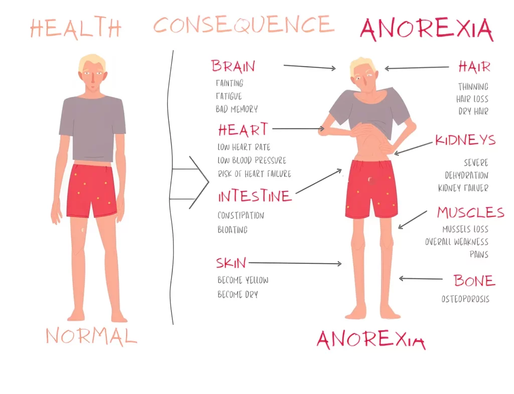 Health consequence anorexia
