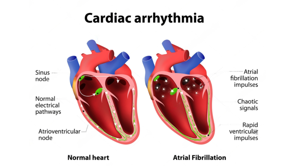 cardiac arrhythmia and it's effects
